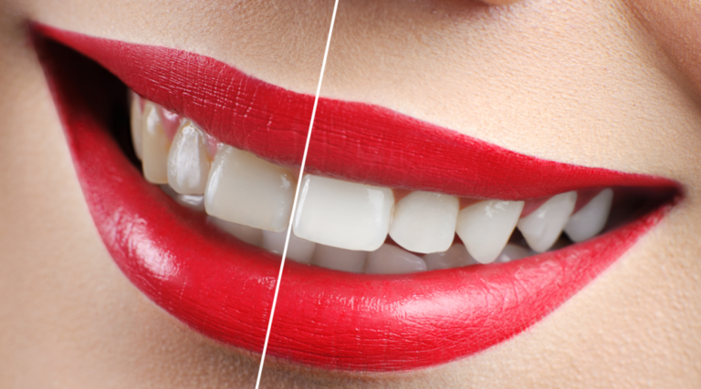 The Ultimate Guide to Teeth Whitening in Etobicoke: Transform Your Smile Today!