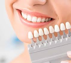 Achieve a Stunning Smile with Veneers in Rockville MD: Your Ultimate Guide