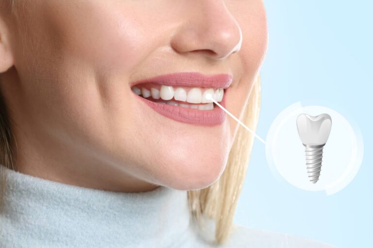 Transform Your Smile with Dental Implants in Barrington: A Comprehensive Guide