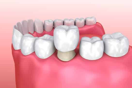 Transform Your Smile: The Ultimate Guide to Dental Crowns in Edmonton