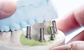 Transform Your Smile with Dental Implants in Northeast Philadelphia: A Comprehensive Guide