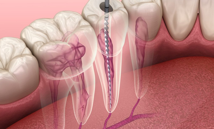 Understanding Root Canal Procedures in Stuart, FL: What You Need to Know