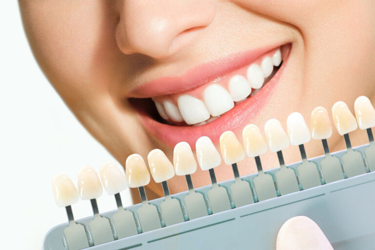 Transform Your Smile with Dental Veneers in Ajax: A Comprehensive Guide